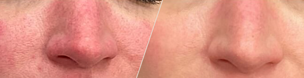 Redness & Rosacea