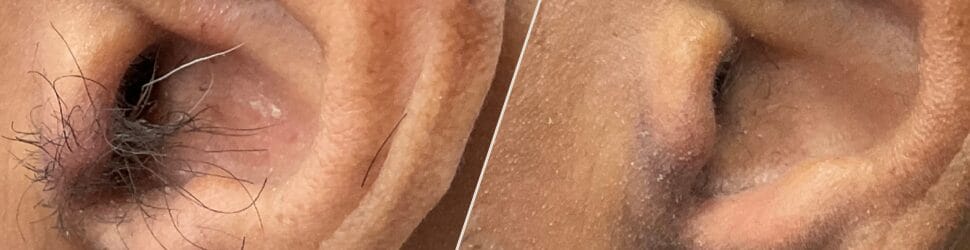 unwanted hair