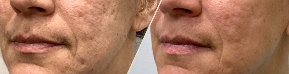 Acne & Scars
