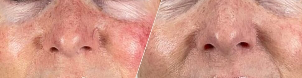 Redness & Rosacea