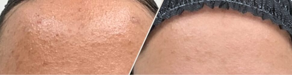 Acne & Scars