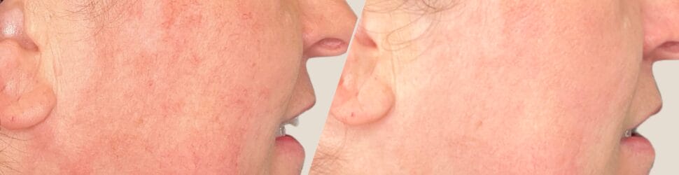 Redness & Rosacea