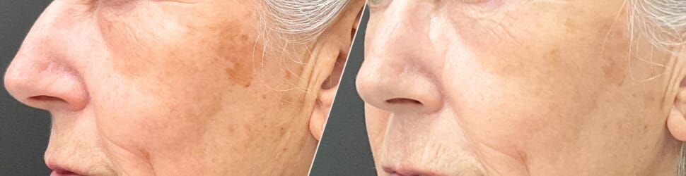 Sun Damage