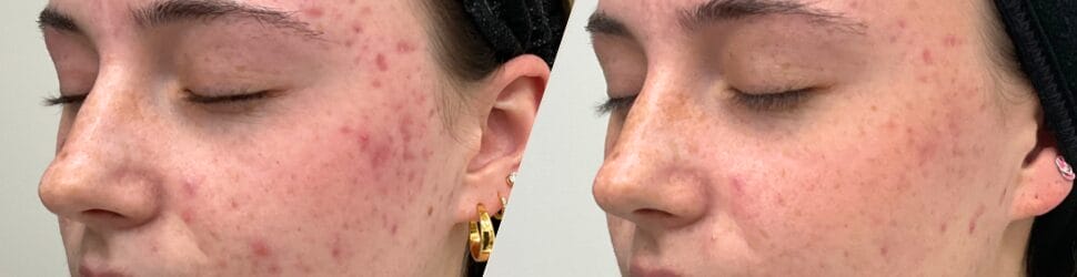 acne & scars