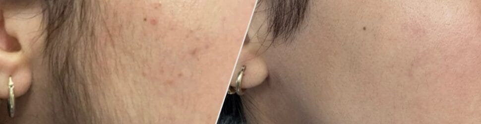 Unwanted Hair