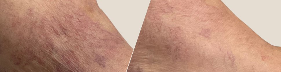 spider veins